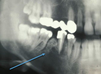 <p>extensive infiltration, poorly defined borders, RL/ RO varies, +/ - root resorption, symmetrical PDL widening </p>