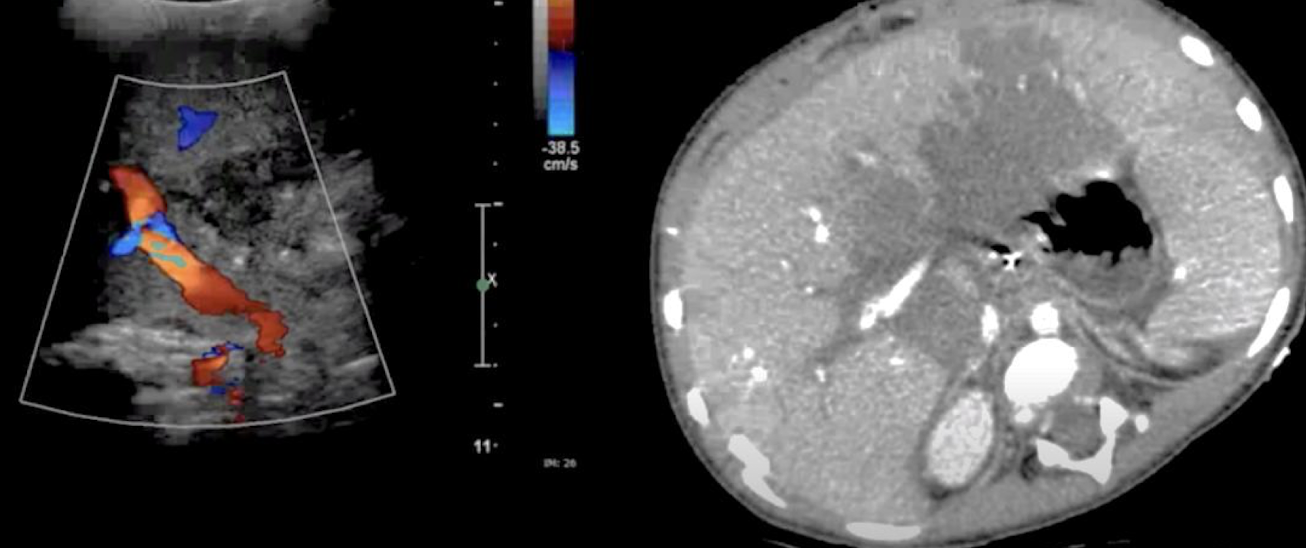 <p>HA thrombosis..</p><ul><li><p></p></li></ul><p></p>