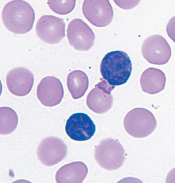 <p>What lymphocytotic pathogen causes is displayed in this smear? What characteristic of the lymphocytes shows this?</p>