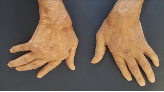 <p>Associated with Rheumatoid Arthritis </p>