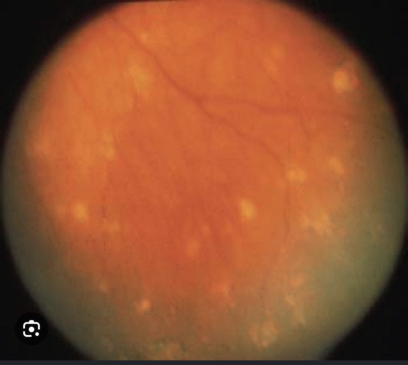 <p>Symp ophthalmitis - Which nodules?</p>