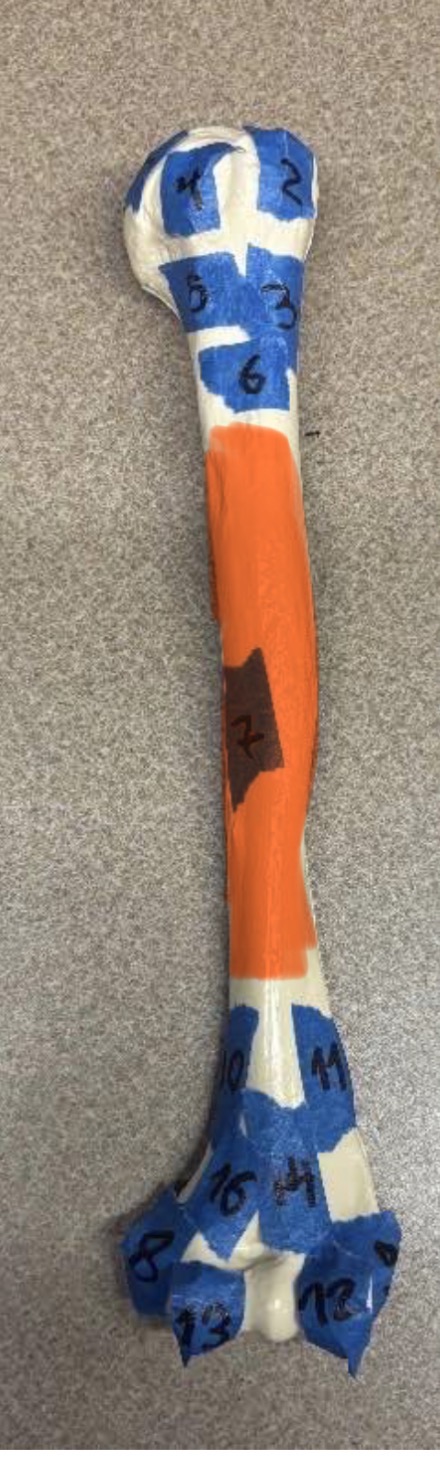 <p>*pronation on the shaft</p><p></p>