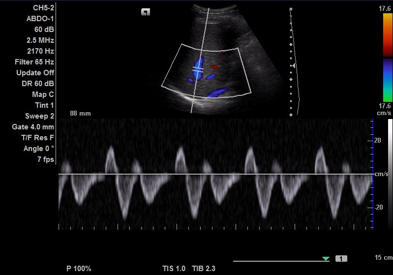 <p>When above baseline: retrograde / hepatopetal / toward usg probe.<br>When below baseline: anterograde / toward heart/hepatofugal / away from usg probe. </p><p>A-wave: Atrial contraction, retrograde/hepatopetal flow</p><p>S-wave: Ventricular systole, large volumes of blood return to atrium. Anterograde flow. </p><p>V-wave: Atrial overfilling, followed by tricuspid valve opening (peak V-wave) and early diastolic filling of right ventricle. Peak should be just below baseline. </p><p>D- wave: Continued fillig of right ventricle during ventricular diastole, some blood flows retrograde to right atrium.</p>