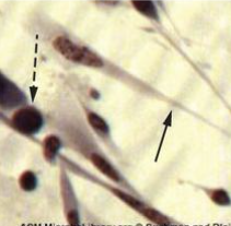 <p>cytoplasmic stranding (arrow) and nuclear inclusion bodies (dashed arrow)</p>
