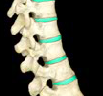 <p>between adjacent vertebral bodies of spinal column</p>