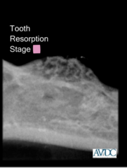 <p>what stage of tooth resorption is this?</p>