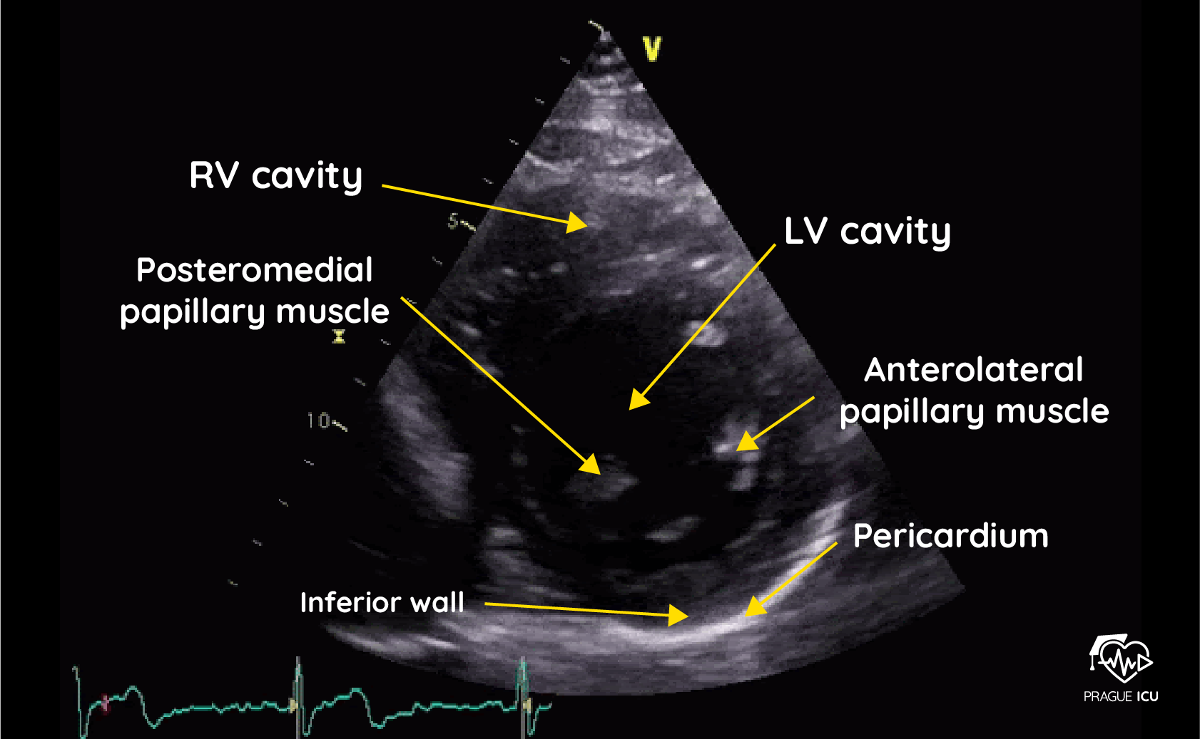 <p><strong>How to Know You're There:</strong> <span data-name="star" data-type="emoji">⭐</span><br>You know you are in the <strong>PSAX Papillary Muscle Level</strong> imaging plane when you see a perfectly round, donut-shaped Left Ventricle with <strong>two distinct muscle pillars</strong> protruding into the center.</p><p><span data-name="star" data-type="emoji">⭐</span><strong> Tip:</strong><br>This is where thinking about the LV as a <strong>circle</strong> becomes really helpful.</p>