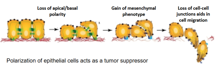 <ul><li><p>de-differentiation</p></li><li><p>epithelial to mesenchymal transition</p></li><li><p>increased migration/invasion</p></li></ul><p></p>
