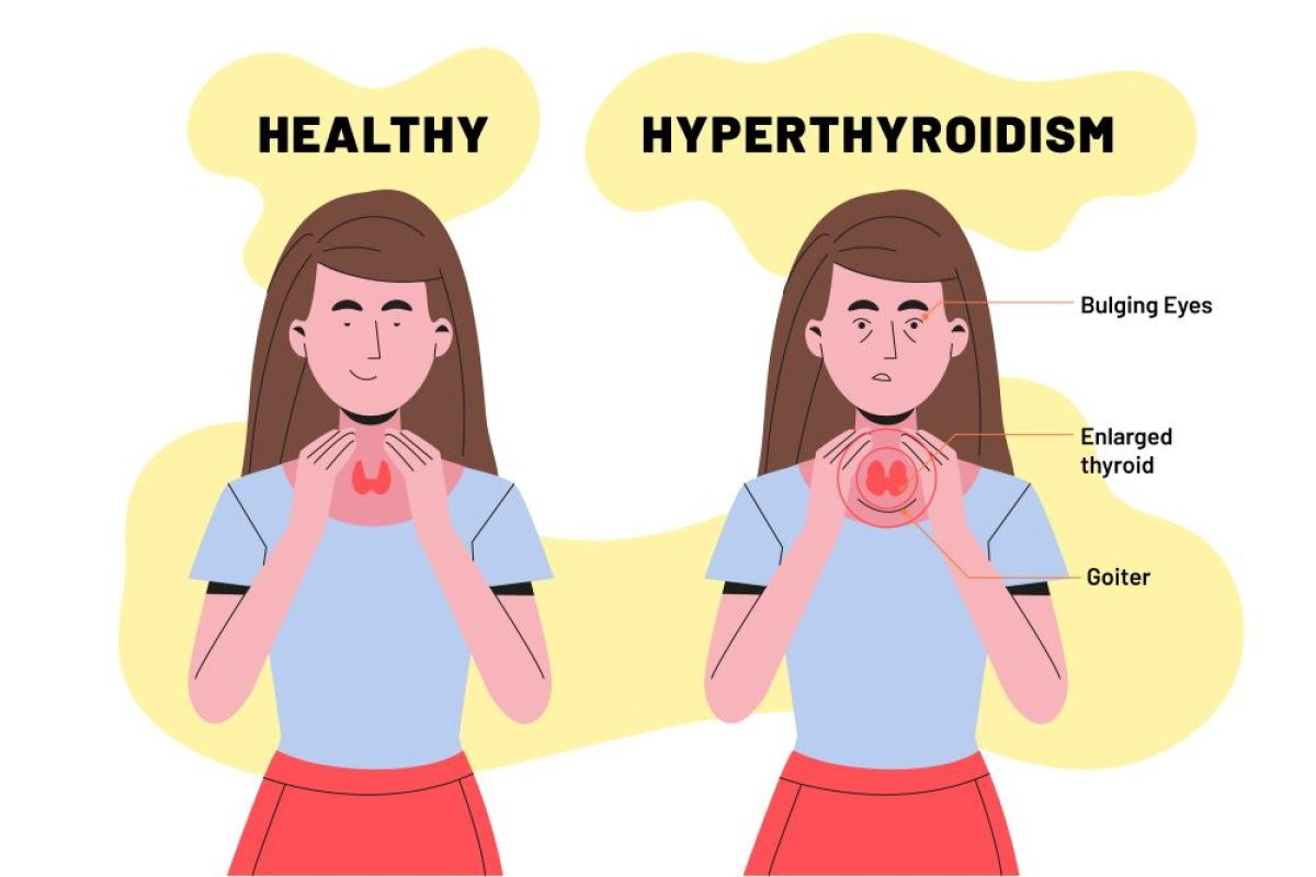 <p>TSH binds to the TSH receptor</p><p>This tells the thyroid to make T3/T4 hormones</p><p>Constitutive activation means the TSH receptor is switched on all the time, even without TSH binding</p><p>The thyroid keeps producing hormones non stop, leading to <strong>hyperthyroidism</strong></p>