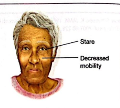 <p>neurodegenerative disease</p><p>linked to the loss of dopamine</p><p>DECREASED facial mobility</p><p>masklike facies</p><p>decreased blinking</p><p>characteristic stare</p><p>neck and upper trunk tend to flex forward</p><p>pt seems to peer upward toward observer</p><p>facial skin: oily</p><p>drooling may occur</p>