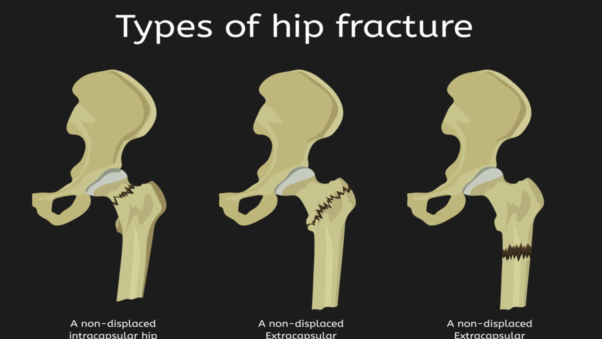 <p>Pelvic fracture</p>