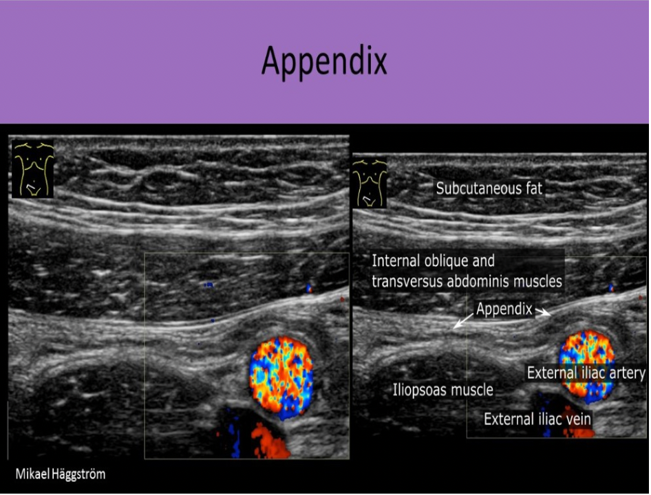 <p>A. posterior to the terminal ileum and anterior to the iliac vessels</p><p>The appendix is also referred to as the vermiform appendix. It originates from the cecum in most patients and can be identified posterior to the terminal ileum and anterior to the iliac vessels.</p>