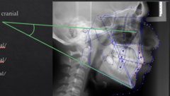 <p>What skeletal measurement:</p><p>- Frankfort Horizontal vs. Mandibular Plane</p><p>- Vertical relationship between the cranial base and the mandible</p><p>- Tells you about the vertical angulation of the mandible</p>