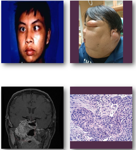 <p><strong>•Malignant epithelial tumor of nasopharynx</strong></p><p><strong>•Strongly associated with Epstein-Barr virus</strong></p><p>•Higher incidence in specific populations</p><p>•Often presents late due to hidden location</p><p>•Early metastasis to regional lymph nodes</p>