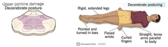<p>What does decerebrate posturing indicate anatomically?</p>