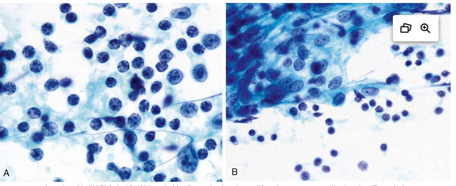 <p>Cytologie glande salivaire </p><p>1) catégorie</p><p>2) diagnostic</p>