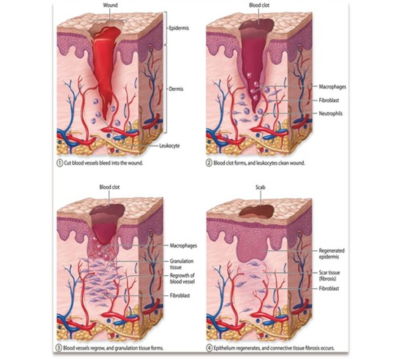 <p>1. Skin surface damaged</p><p>2. Exposure of platelets to damaged blood vessel triggers enzyme cascade that causes a blood clot to form</p><p>3. Blood clot seals abrasion</p><p>4. As it dries it shrinks, forming a scab and drawing the 2 sides of the injury together</p><p>5. Deposition of collagen begins the processing of repairing the skin</p><p>6. Stem cells differentiate into skin cells and blood vessel cells</p><p>7. Scab is released when skin is repaired</p>