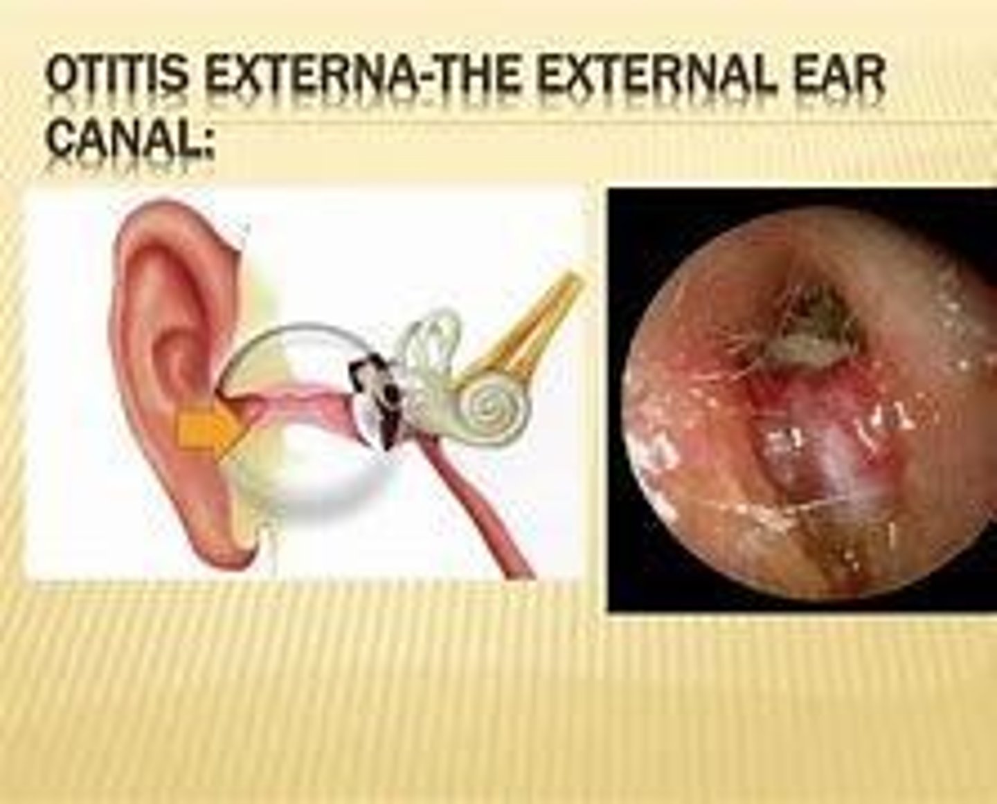 <p>Outer ear canal infection, often due to water exposure.</p>