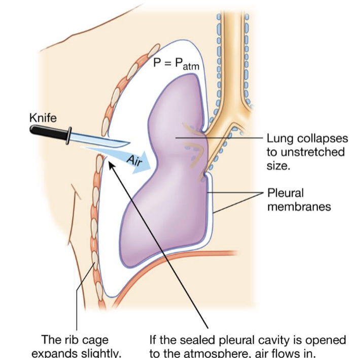 <ul><li><p>if the sealed pleural cavity is opened to the atmosphere, air flows in</p></li><li><p>the bond holding the lung to the chest wall is broken, and the lung collapses, creating air in the thorax</p></li><li><p>positive atmospheric pressure enters through the muscles</p></li><li><p>lost of compliance</p></li></ul><p></p>