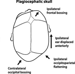 <p>A condition characterized by an asymmetrical head shape.</p>