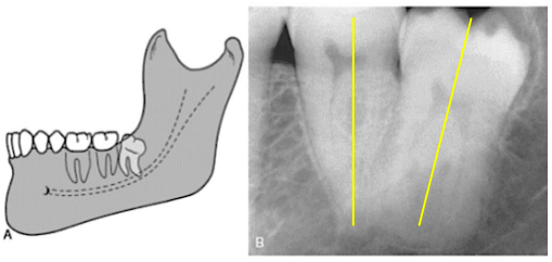 <p>distoangular</p>