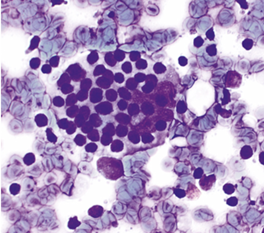 <p>cytologie ganglion lymphatique</p><ul><li><p>diagnostic </p></li><li><p>Nom donné à ce phénomène (photo)</p></li></ul><p></p>