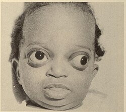 <p>protruding eyeballs</p>
