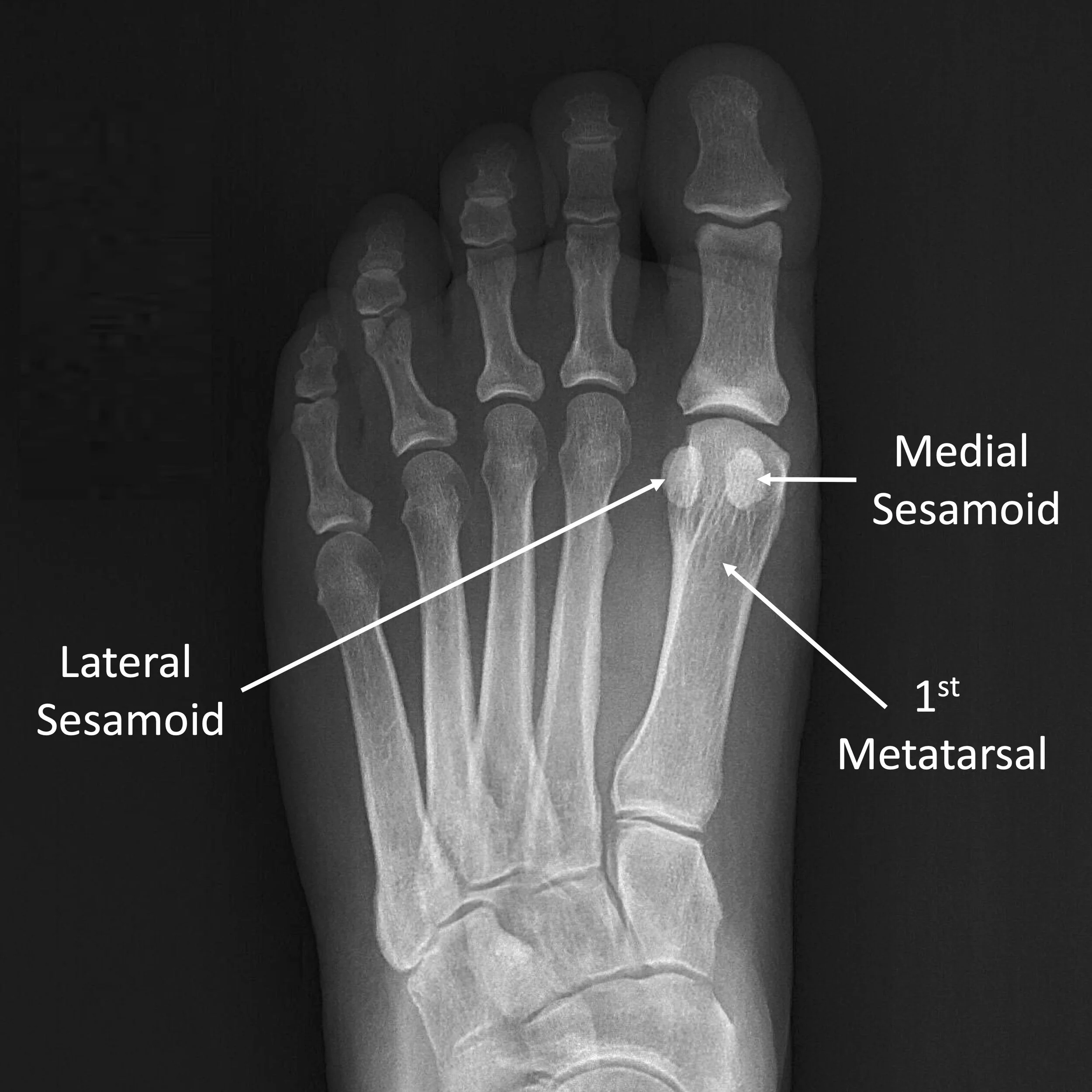 <p>Sesamoid bone</p>
