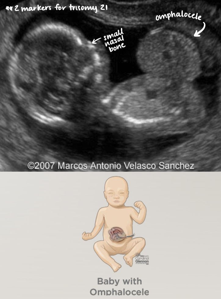 <ul><li><p>bowl or other organs come out, BUT difference is… it will be <span style="color: yellow;">encased in a membrane</span></p><ul><li><p>looks like a contained mass with smooth borders b/c of membrane </p></li></ul></li></ul><p></p>