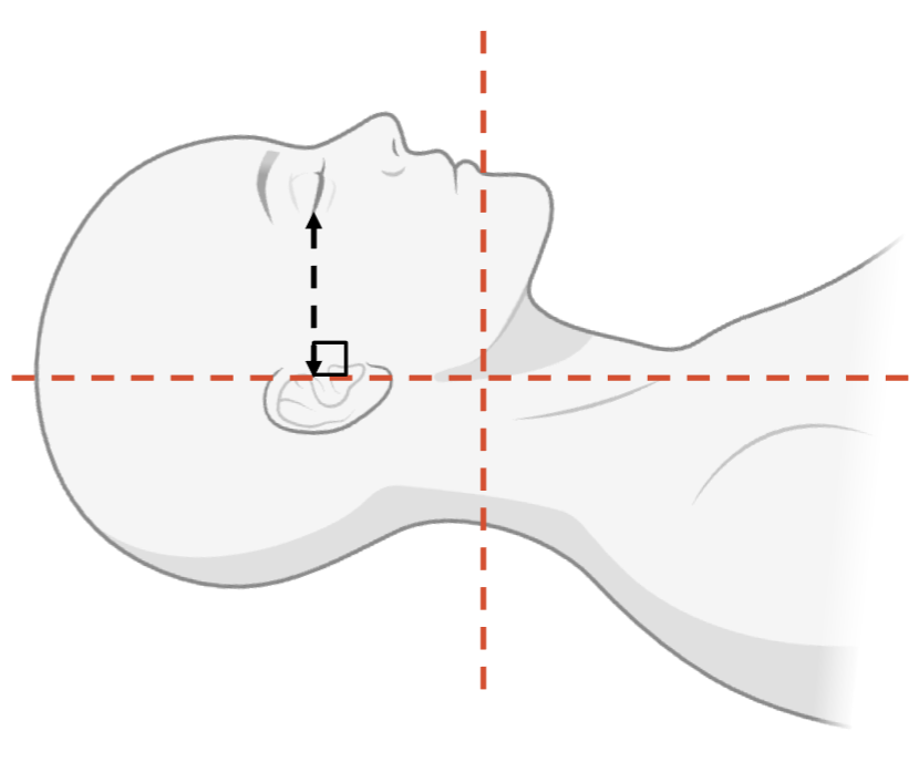 <ul><li><p>Head first</p></li><li><p>Supine</p></li><li><p>Head immobilised in cradle</p></li><li><p>EAM is perpendicular to the OML </p></li></ul><p></p>