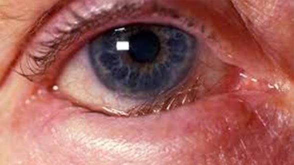 <p>Afección médica en la que el borde del párpado (generalmente el inferior) se pliega o gira hacia el interior del ojo.</p>