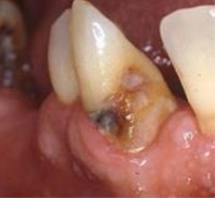 <p>What is the ICDAS for these root caries?</p>