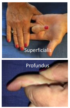 <p>Superficial = bend finger at PIP while holding other three fingers down </p><p>Profundus = isolated PIP and bend at DIP joint</p><ul><li><p>D = bend at DIP joint which is distal </p></li></ul><p></p>