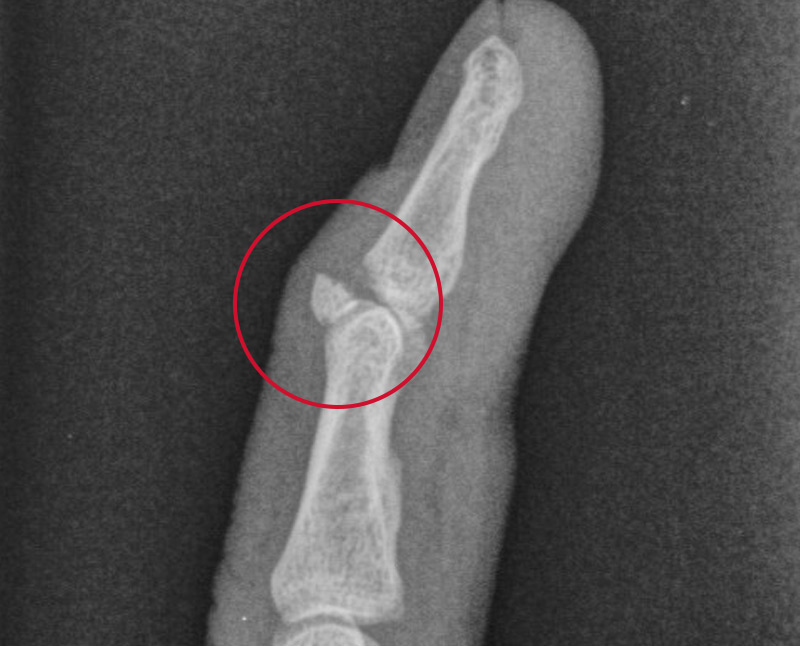 <p>a bone failure caused when a ligament is forcibly ripped from its attachment point, removing a portion of the bone</p>