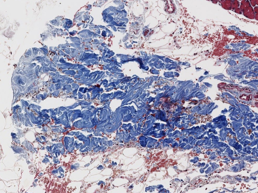 <p>what type of CT is seen outside the lobules (red areas)?</p>
