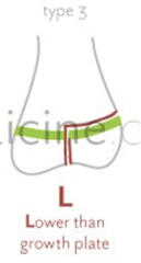 <p>vertical fracture of epiphysis perpendicular to physis, extending into growth plate</p>