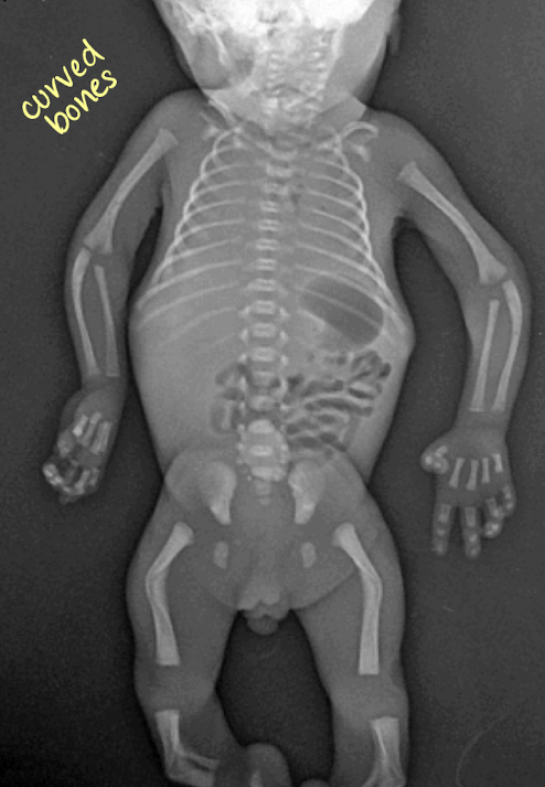 <ul><li><p>aka bent bone (bowed)</p></li><li><p>rare lethal skeletal disorder characterized by <span style="color: yellow;">bowing of the long bone </span>(bent bones)</p><ul><li><p>normal ossification without fractures</p></li><li><p>curvature of long bones</p></li></ul></li><li><p>most spontaneous but could be inherited</p></li><li><p>associated with:</p><ul><li><p>renal, cardiac, and CNS anomalies</p></li><li><p>ambiguous genitalia</p></li></ul></li></ul><p></p>