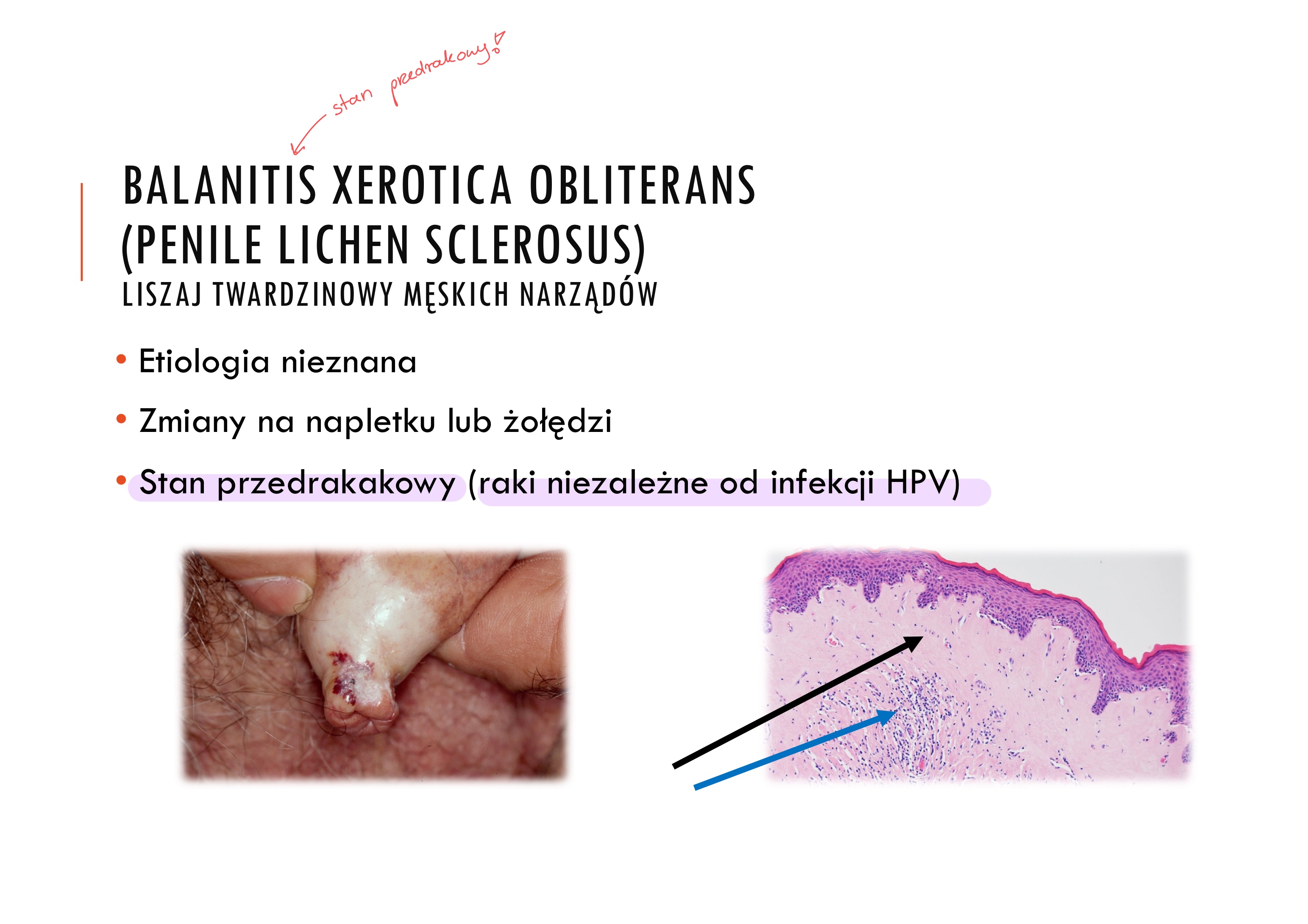 <p>raki niezależne od HPV</p>
