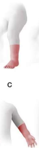 <p>this limb deficiency would be considered ___________</p>