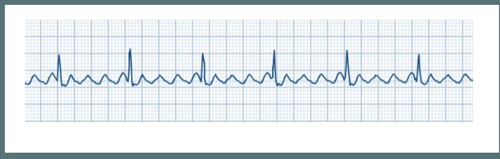 <p>Rate: fast 250-350 BPM for atrial, but ventricular rate is often slower</p><p>P-wave: saw-toothed morphology</p><p>PR interval: not measurable</p><p>QRS: Narrow (<120ms)</p><p>Rhythm: regular atrial and ventricular rates can vary</p>