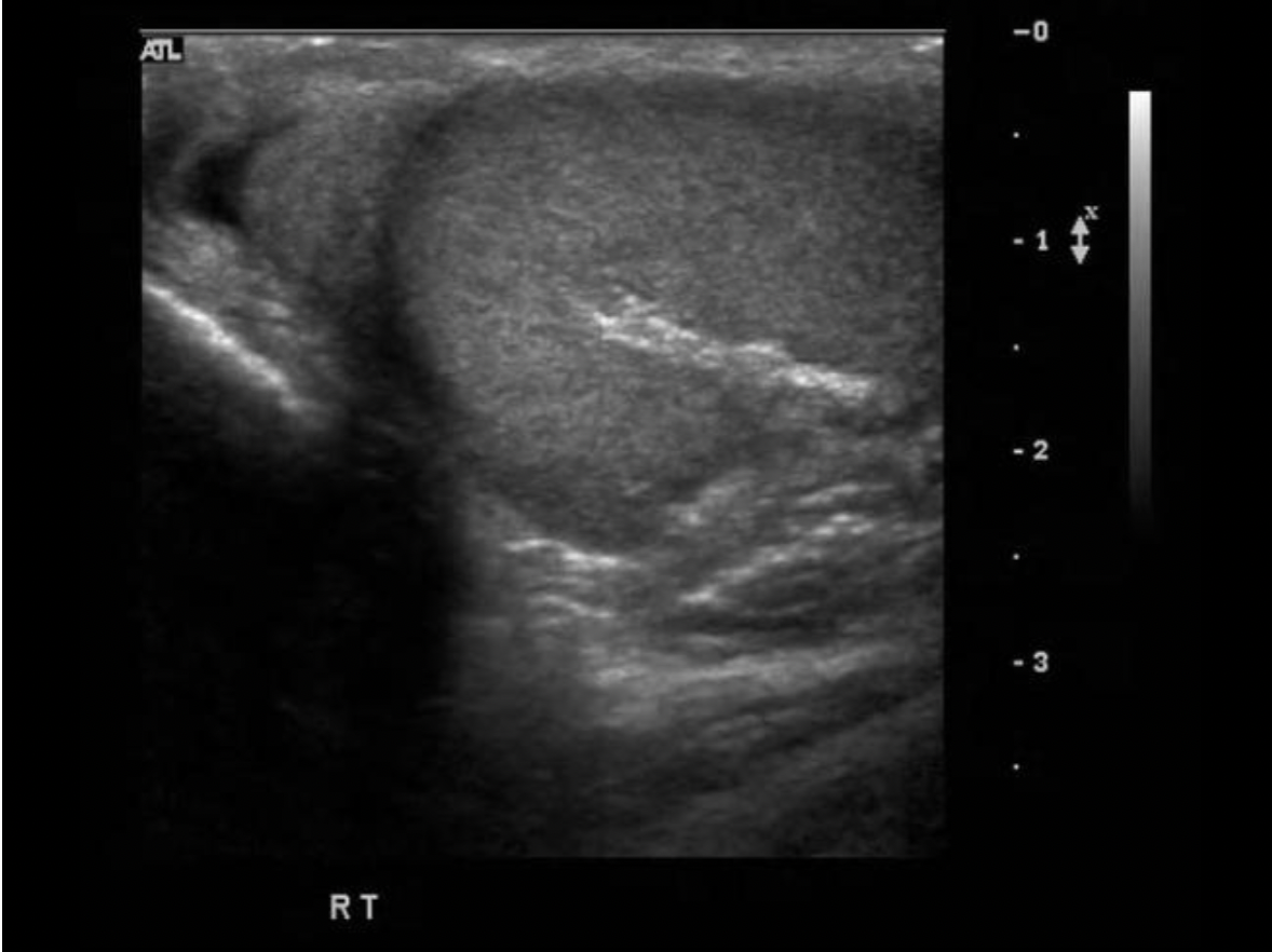 <p>Find the mediastinum testis</p>