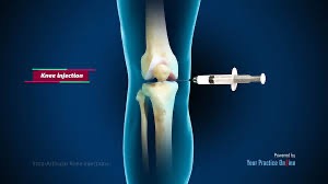 <p>Site: Joint space (injectable liquid) can't administered</p>