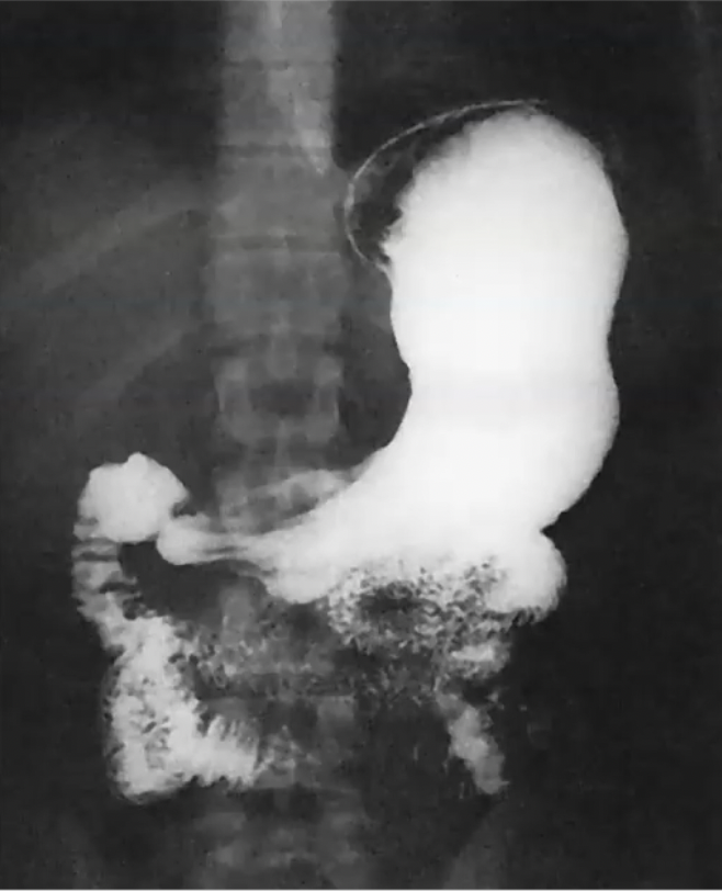 <p>What projection is this? (air in fundus)</p>