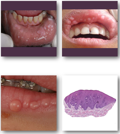 <p>• No treatment needed in most cases</p><p>•<strong> Excision if lesions are traumatized or persistent</strong></p><p>• Cryotherapy or laser for symptomatic lesions</p><p>• Recurrence possible after removal or regression</p><ul><li><p>No malignant transformation risk reported</p></li></ul><p></p>