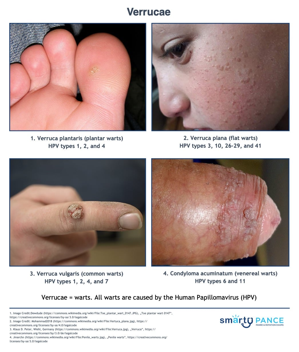 <p>Warts caused by human papillomavirus (HPV)</p><p>-Can be seen on the fingers, elbows, knees, face, soles/heels, genitals, eyelids</p><p>-Dx: clinical </p><p>-Tx: salicylic acid, cryotherapy </p>