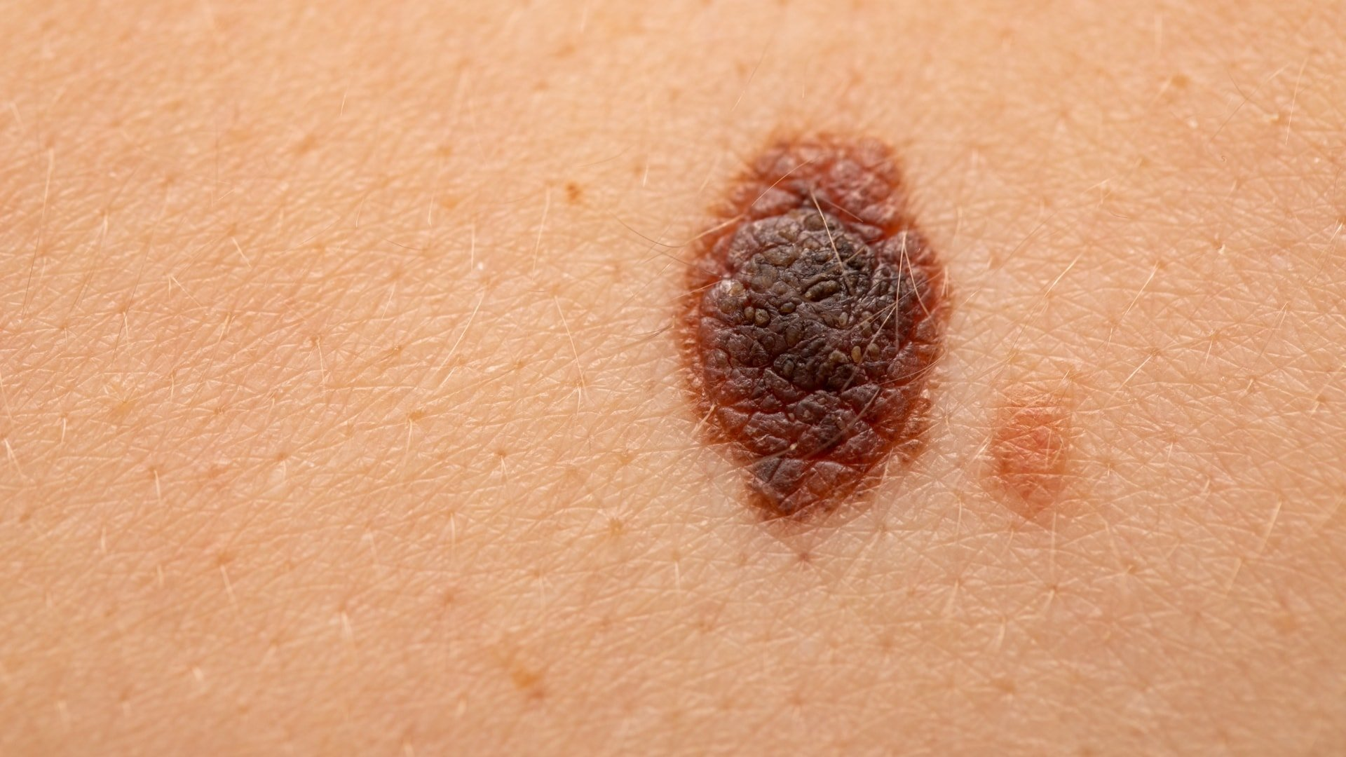 <p>Melanoma</p>