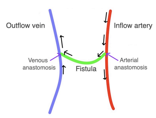 <p>What waveforms will you see in someone with dialysis (inflow and outflow) </p>