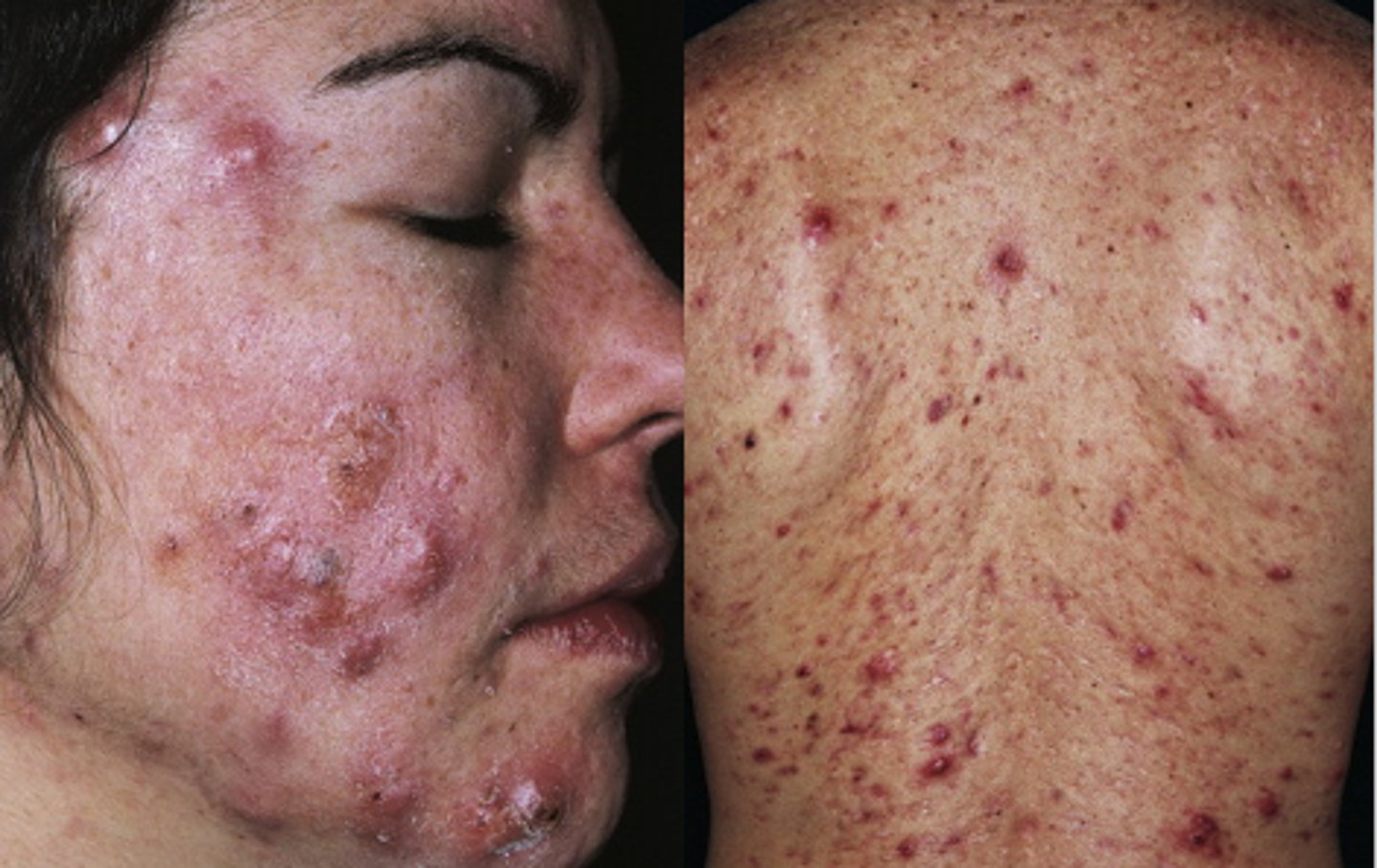 <p>Characterized by inflammatory hard lesions found deeper in the skin at the point where the hair follicle becomes plugged w/ dead skin cells (usually PAINFUL/TENDER) </p>