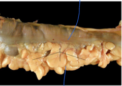 <p>5) This part of the Gl tract receives blood supply from (check all that applies):</p><p>A) Gastroduodenal artery</p><p>B) SMA</p><p>C) Marginal artery</p><p>D) Superior Pancreaticoduodenal</p>