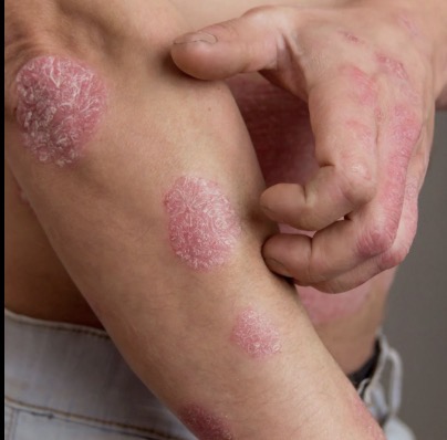 <ul><li><p>annular lesions that grow together</p></li><li><p>Ex: psoriasis </p></li></ul><p></p>